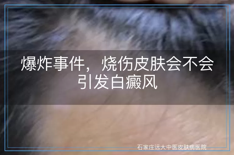 爆炸事件，烧伤皮肤会不会引发白癜风