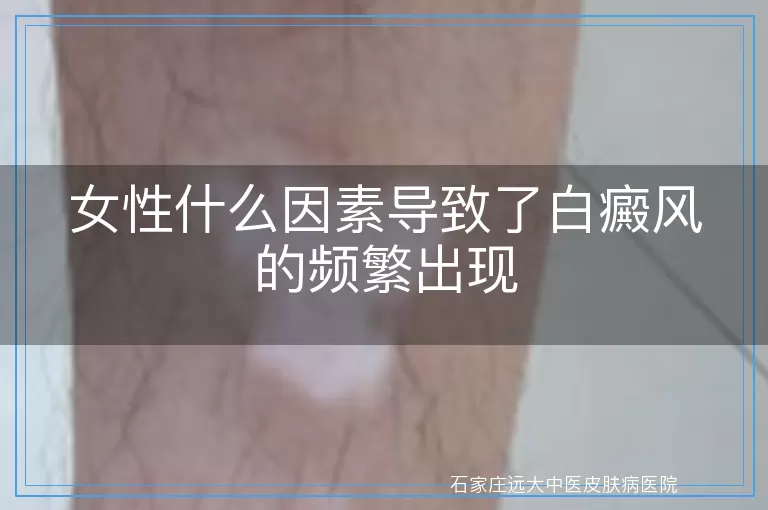 女性什么因素导致了白癜风的频繁出现
