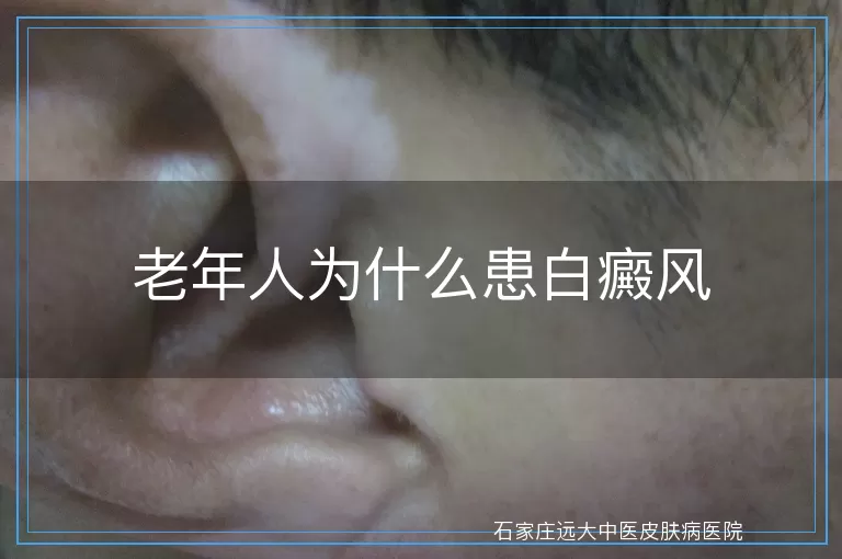 老年人为什么患白癜风
