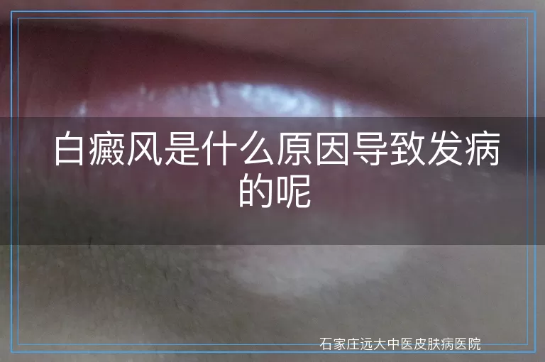 白癜风是什么原因导致发病的呢