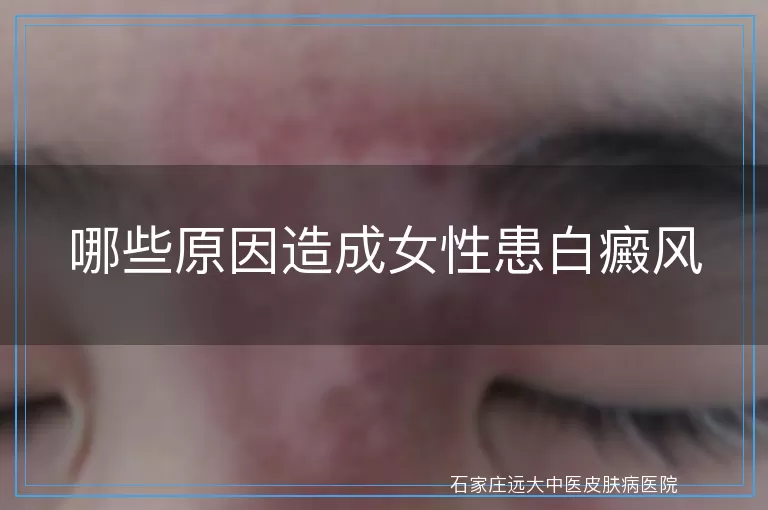 哪些原因造成女性患白癜风