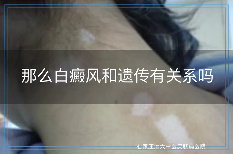 那么白癜风和遗传有关系吗