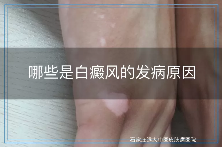 哪些是白癜风的发病原因
