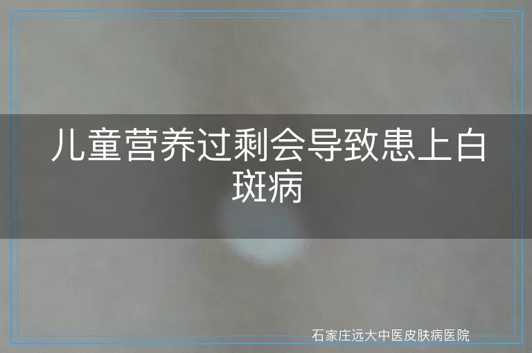 儿童营养过剩会导致患上白斑病