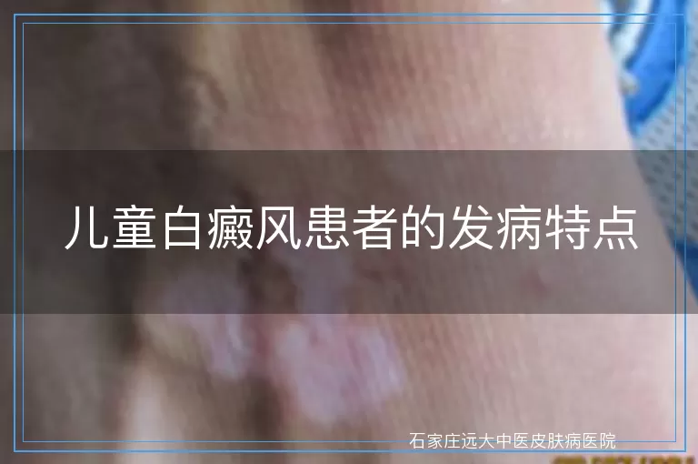 儿童白癜风患者的发病特点