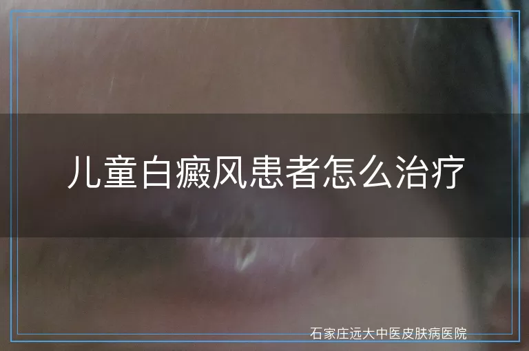 儿童白癜风患者怎么治疗
