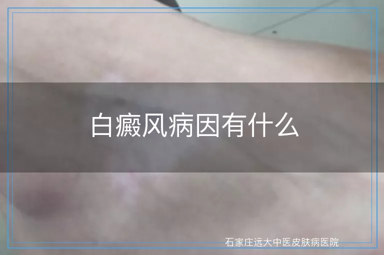 白癜风病因有什么