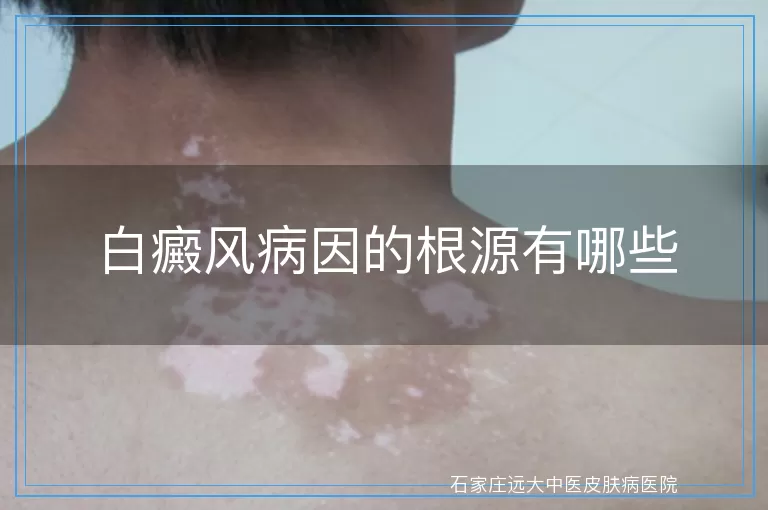 白癜风病因的根源有哪些