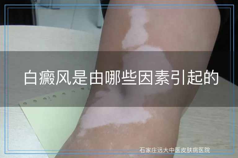 白癜风是由哪些因素引起的