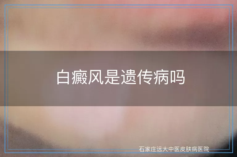 白癜风是遗传病吗