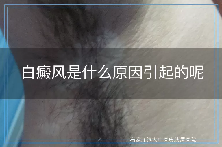 白癜风是什么原因引起的呢