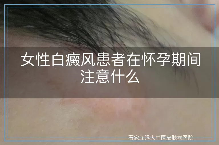 女性白癜风患者在怀孕期间注意什么