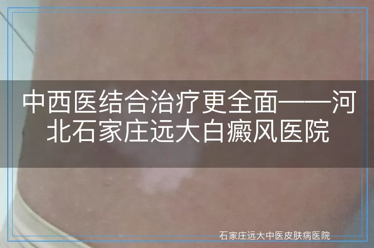 中西医结合治疗更全面——河北石家庄远大白癜风医院