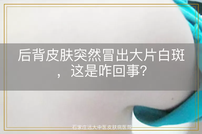 后背皮肤突然冒出大片白斑，这是咋回事？
