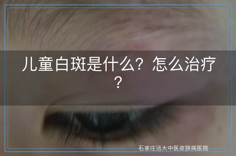 儿童白斑是什么？怎么治疗？