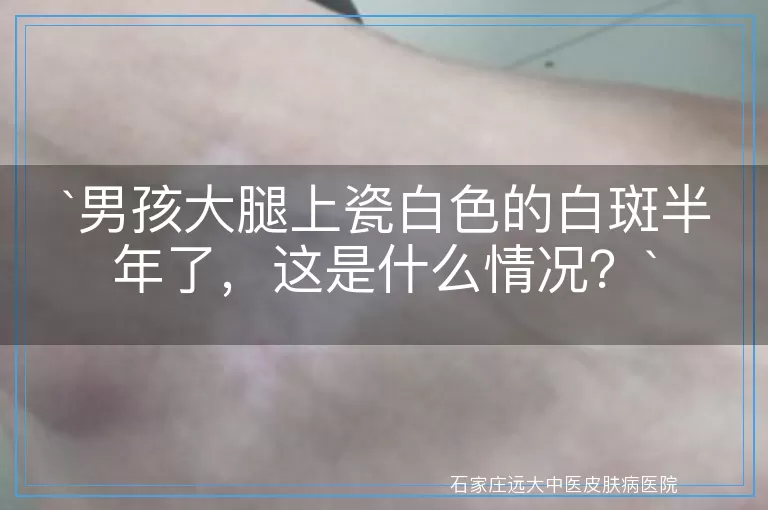 男孩大腿上瓷白色的白斑半年了，这是什么情况？