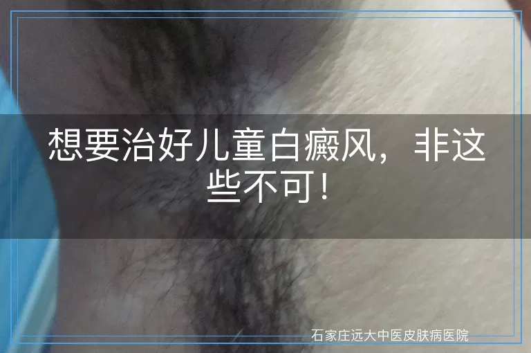 想要治好儿童白癜风，非这些不可！