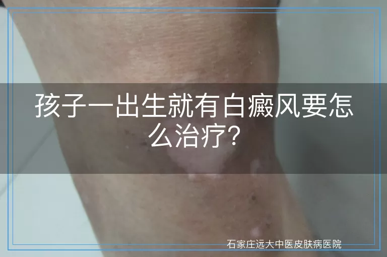 孩子一出生就有白癜风要怎么治疗？