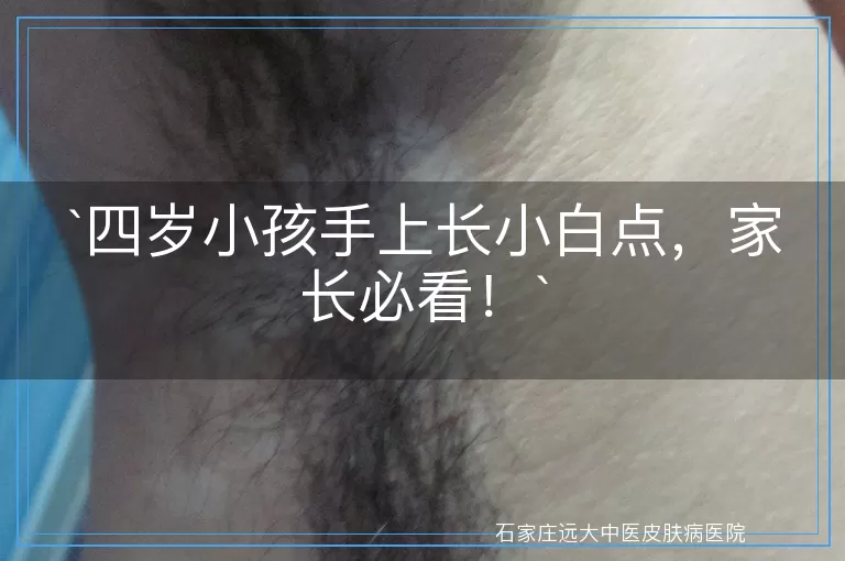 四岁小孩手上长小白点,家长必看!