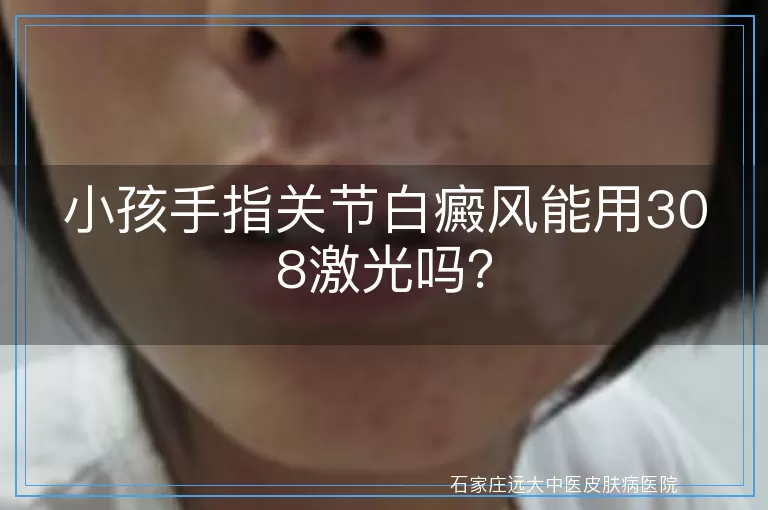 小孩手指关节白癜风能用308激光吗？