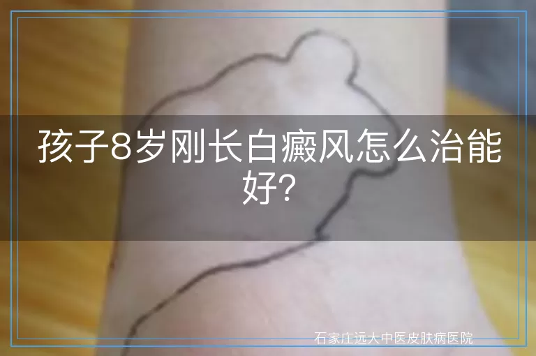 孩子8岁刚长白癜风怎么治能好？