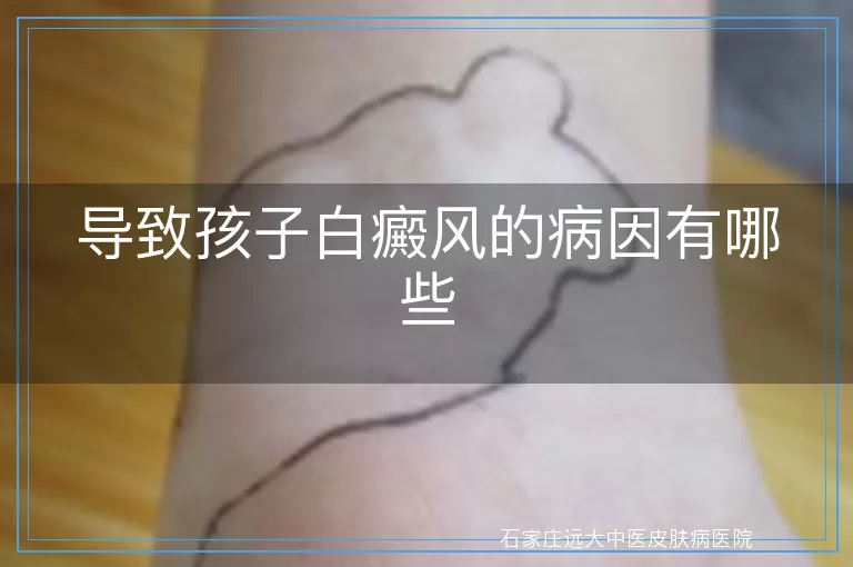 导致孩子白癜风的病因有哪些