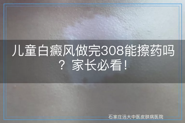 儿童白癜风做完308能擦药吗？家长必看！