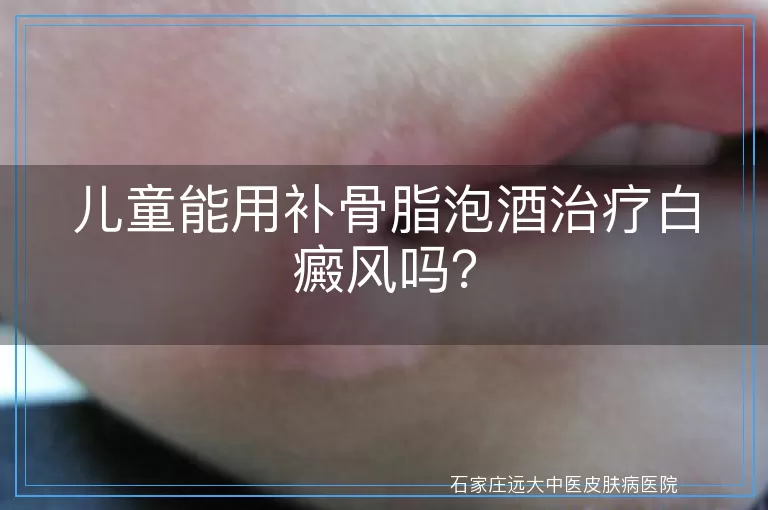 儿童能用补骨脂泡酒治疗白癜风吗？