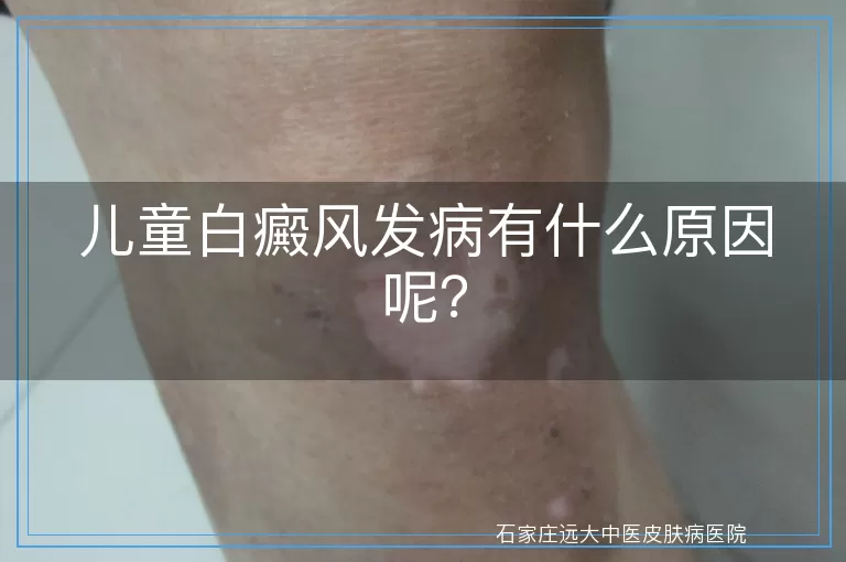 儿童白癜风发病有什么原因呢？