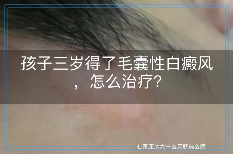 孩子三岁得了毛囊性白癜风，怎么治疗？