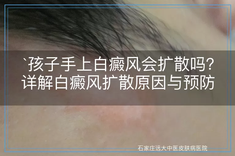 孩子手上白癜风会扩散吗？详解白癜风扩散原因与预防措施
