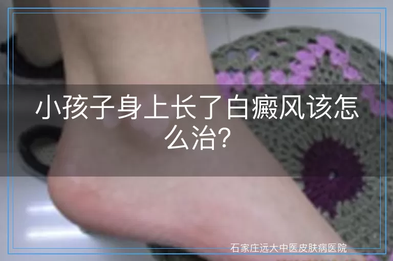 小孩子身上长了白癜风该怎么治？