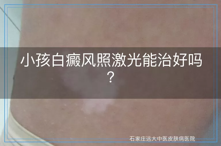 小孩白癜风照激光能治好吗？