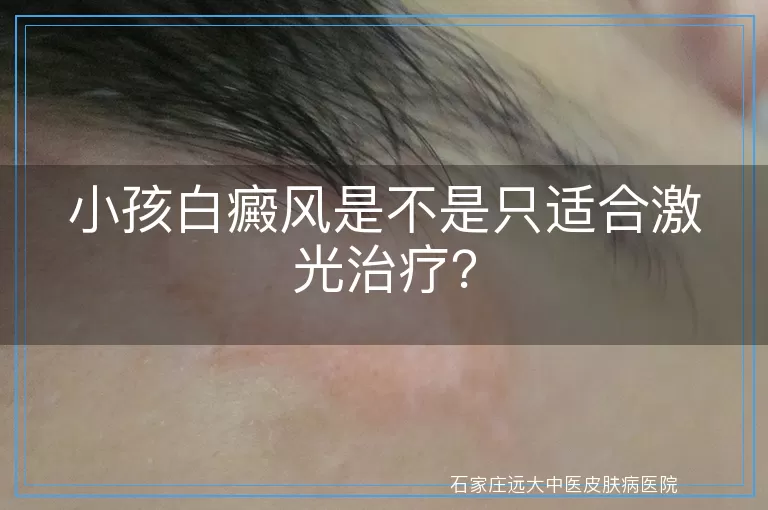 小孩白癜风是不是只适合激光治疗？
