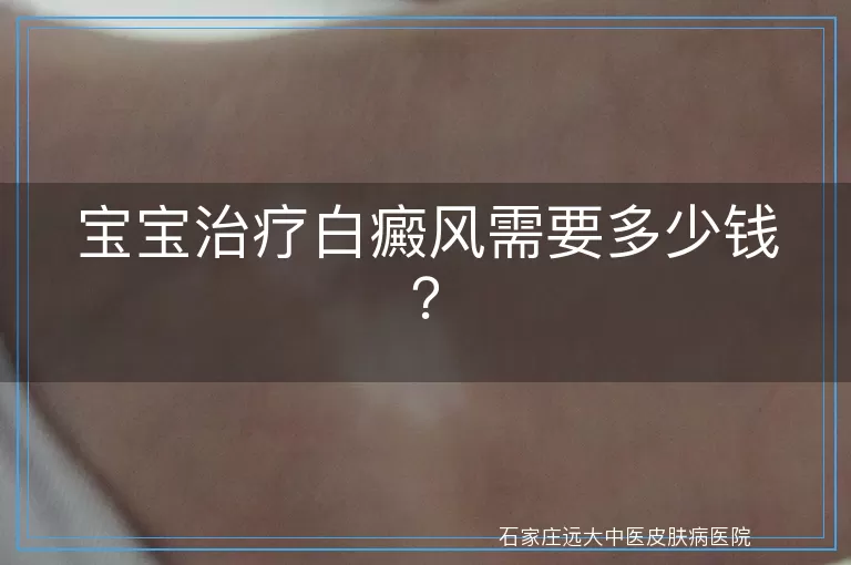 宝宝治疗白癜风需要多少钱？