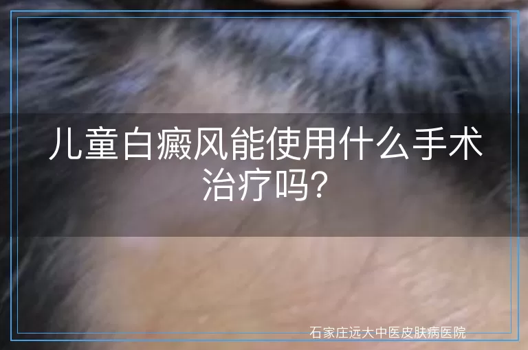 儿童白癜风能使用什么手术治疗吗？