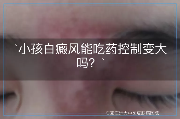 小孩白癜风能吃药控制变大吗？