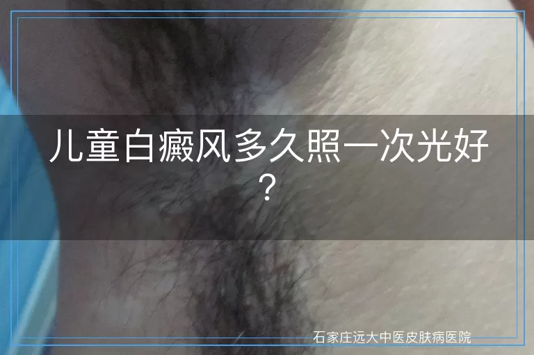 儿童白癜风多久照一次光好？
