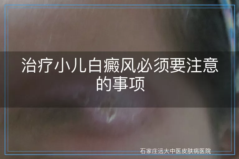 治疗小儿白癜风必须要注意的事项