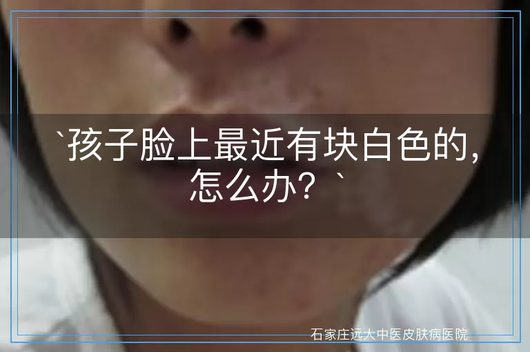 孩子脸上最近有块白色的，怎么办？