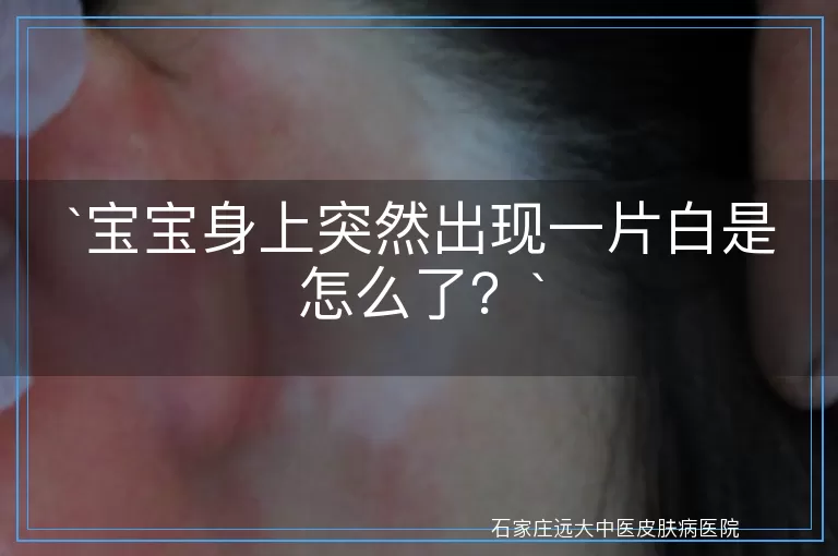 宝宝身上突然出现一片白是怎么了？