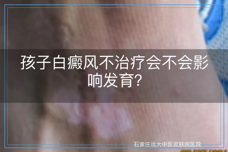 孩子白癜风不治疗会不会影响发育？