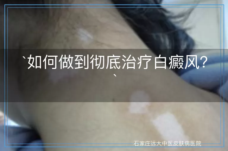 如何做到彻底治疗白癜风？