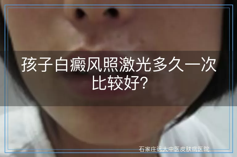 孩子白癜风照激光多久一次比较好？