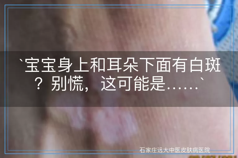 宝宝身上和耳朵下面有白斑？别慌，这可能是……