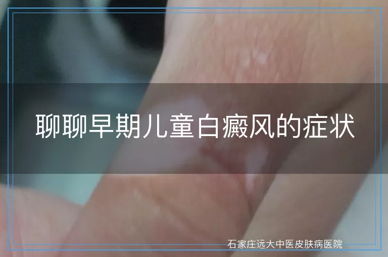 聊聊早期儿童白癜风的症状