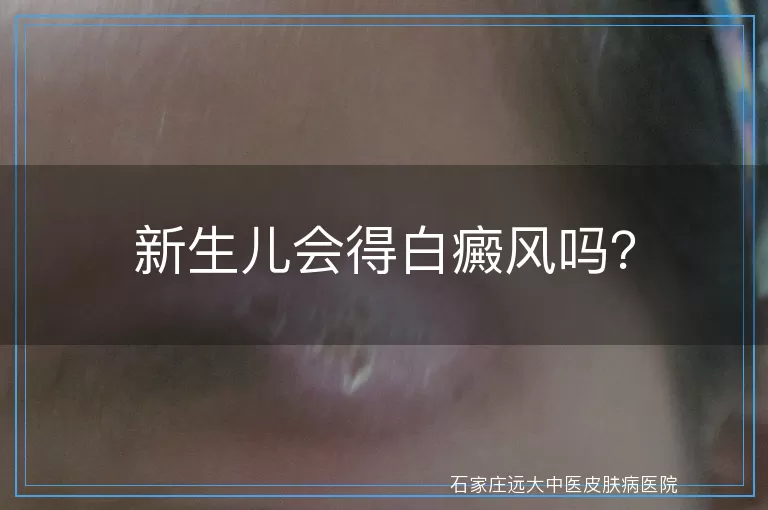 新生儿会得白癜风吗？