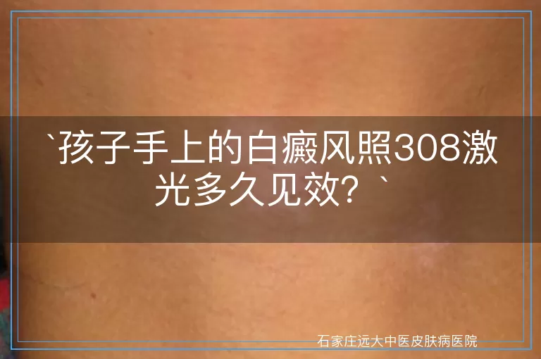 孩子手上的白癜风照308激光多久见效？