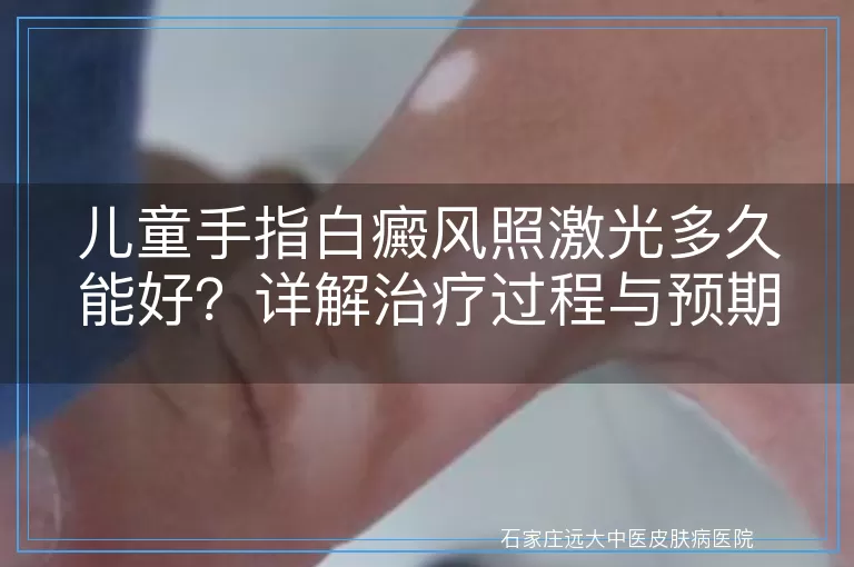 儿童手指白癜风照激光多久能好？详解治疗过程与预期