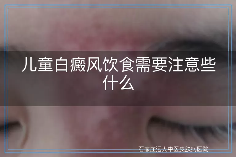儿童白癜风饮食需要注意些什么